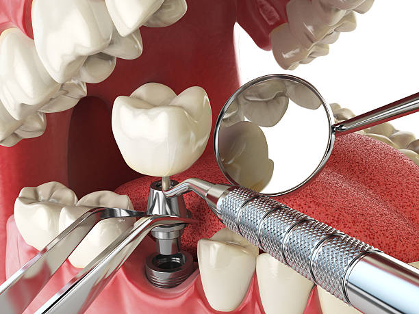 Best Broken or Cracked Tooth Emergency Dentist in Dove Valley, CO